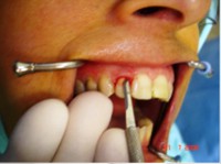 /album/galeria-de-fotos-carga-imediata-apos-exodontia-atraumatica-/carga-imediata-com-exodontia-atraumatica2-jpg/